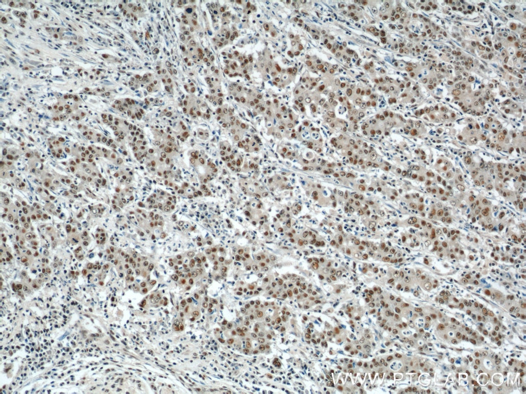Immunohistochemistry (IHC) staining of human stomach cancer tissue using CDK8 Polyclonal antibody (22067-1-AP)