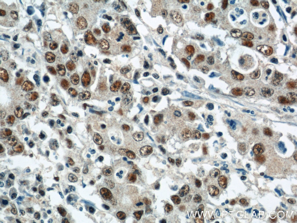 Immunohistochemistry (IHC) staining of human stomach cancer tissue using CDK8 Polyclonal antibody (22067-1-AP)