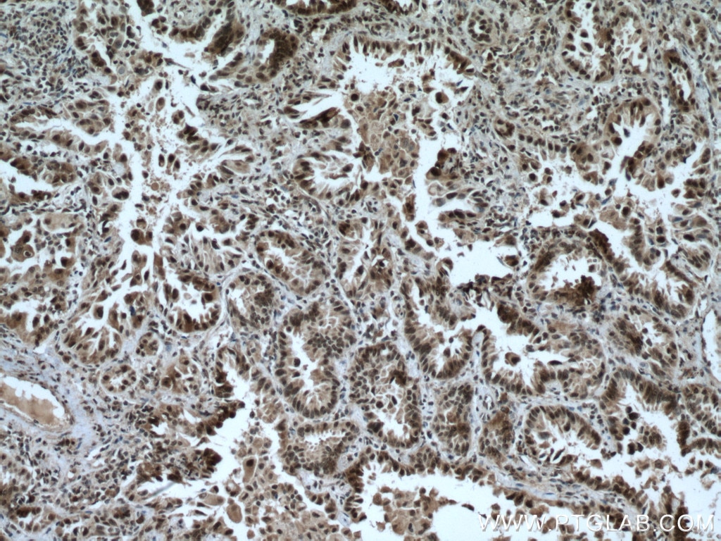 IHC staining of human lung cancer using 11705-1-AP