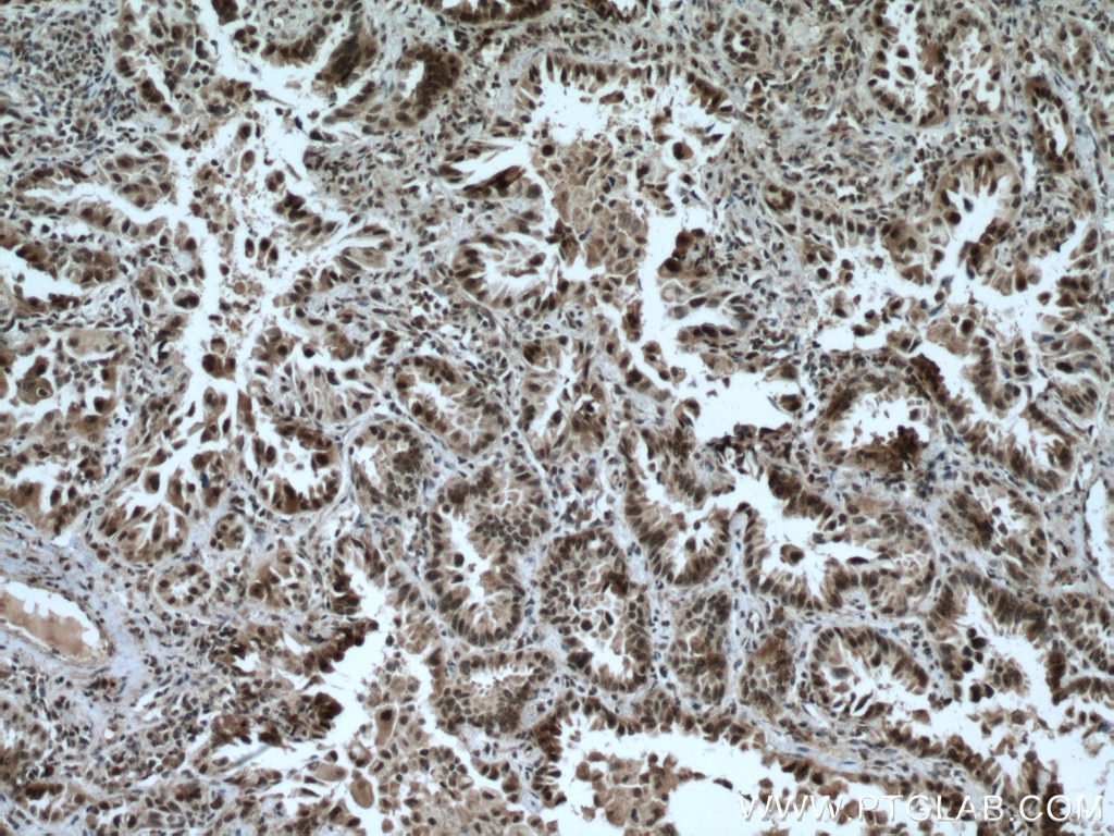 Immunohistochemistry (IHC) staining of human lung cancer tissue using CDK9 Polyclonal antibody (11705-1-AP)