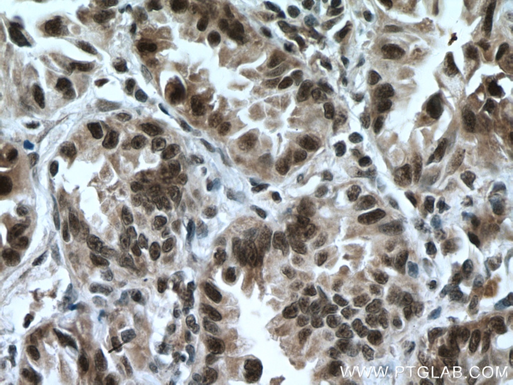 Immunohistochemistry (IHC) staining of human lung cancer tissue using CDK9 Polyclonal antibody (11705-1-AP)