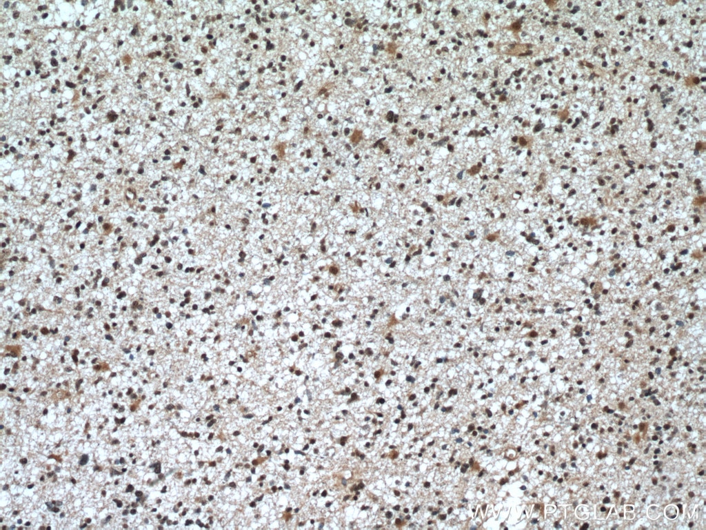 Immunohistochemistry (IHC) staining of human gliomas tissue using CDK9 Polyclonal antibody (11705-1-AP)