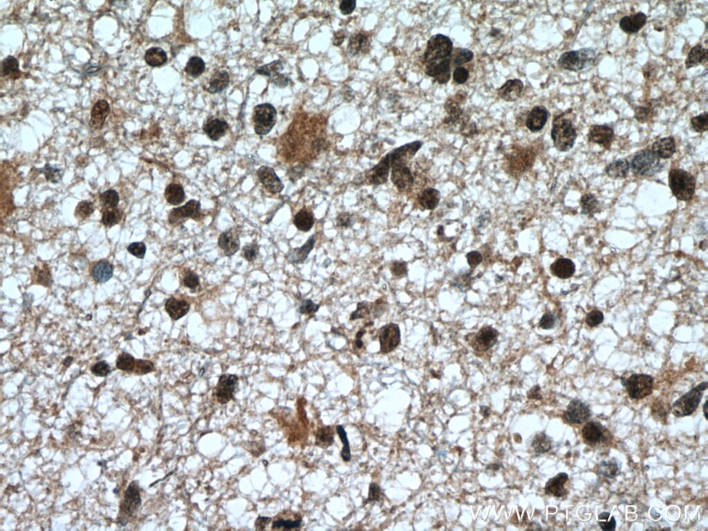 IHC staining of human gliomas using 11705-1-AP