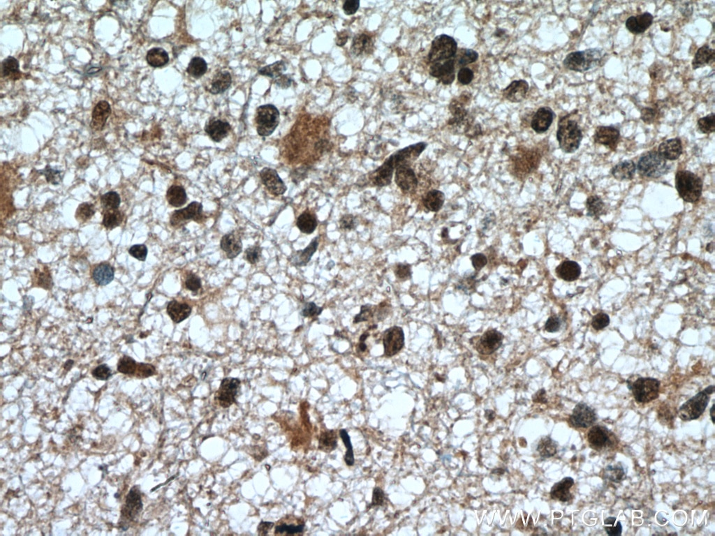 Immunohistochemistry (IHC) staining of human gliomas tissue using CDK9 Polyclonal antibody (11705-1-AP)