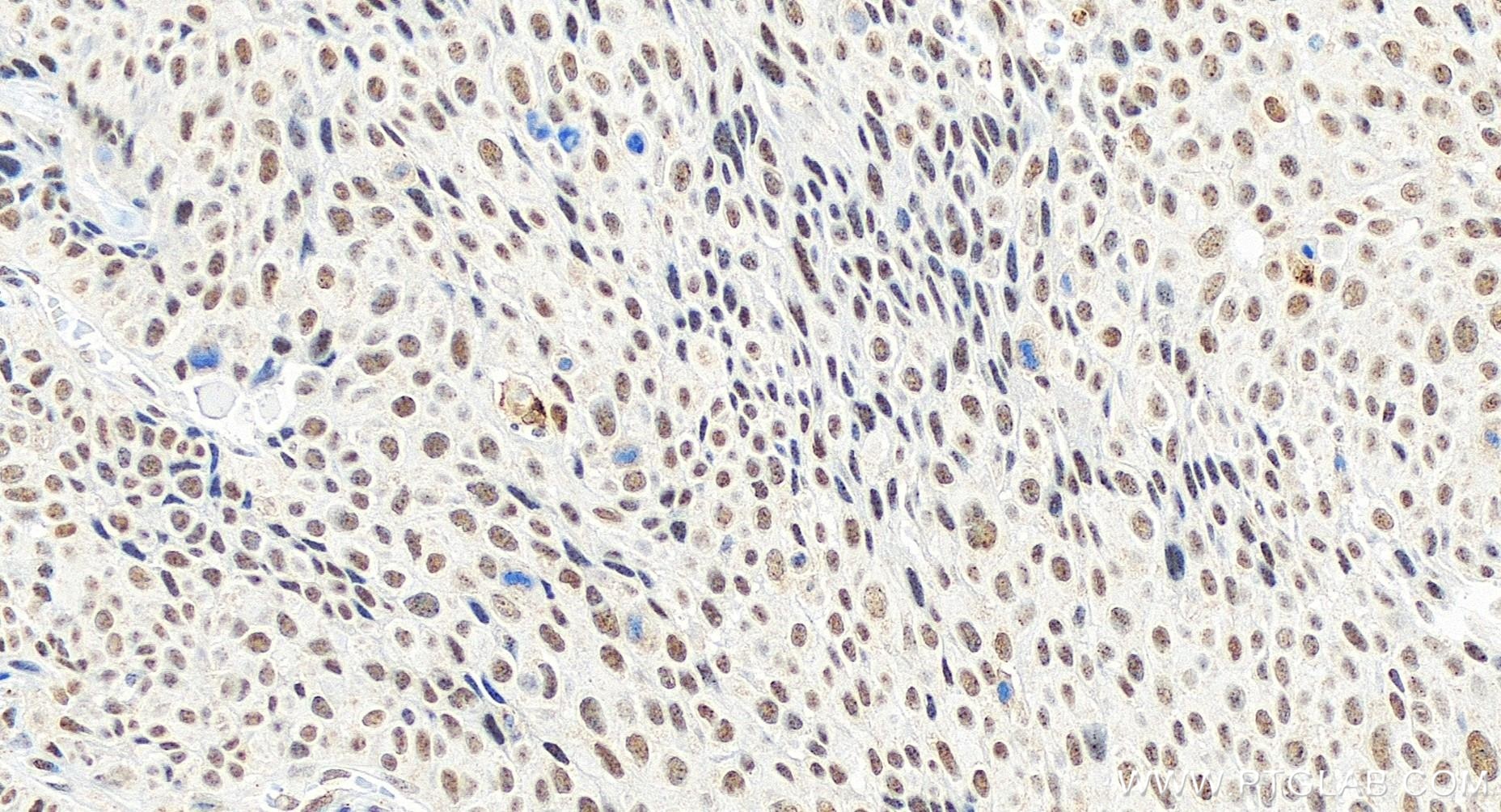 Immunohistochemistry (IHC) staining of human lung cancer tissue using CDK9 Recombinant antibody (83662-7-RR)