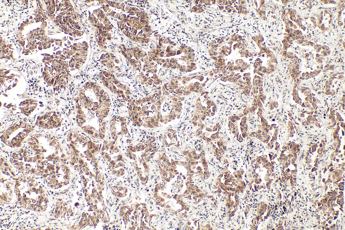 Immunohistochemical analysis of paraffin-embedded human lung cancer tissue slide using RMX00056 (CDK9 antibody) at dilution of 1:600 (under 10x lens). Heat mediated antigen retrieval with Tris-EDTA buffer (pH 9.0). Immunohistochemistry (IHC) staining of human lung cancer tissue using Multi-rAb® CDK9 Multi-Recombinant antibody (RMX00056)
