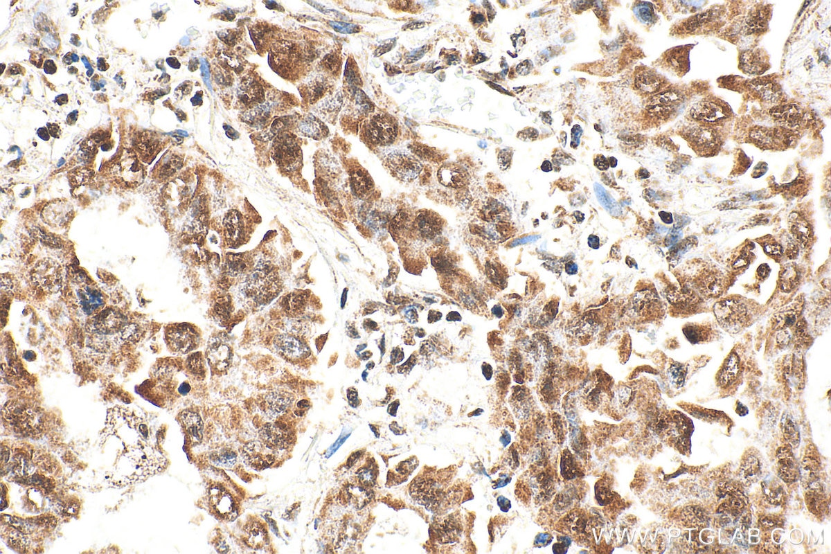Immunohistochemical analysis of paraffin-embedded human lung cancer tissue slide using RMX00056 (CDK9 antibody) at dilution of 1:600 (under 40x lens). Heat mediated antigen retrieval with Tris-EDTA buffer (pH 9.0). Immunohistochemistry (IHC) staining of human lung cancer tissue using Multi-rAb® CDK9 Multi-Recombinant antibody (RMX00056)