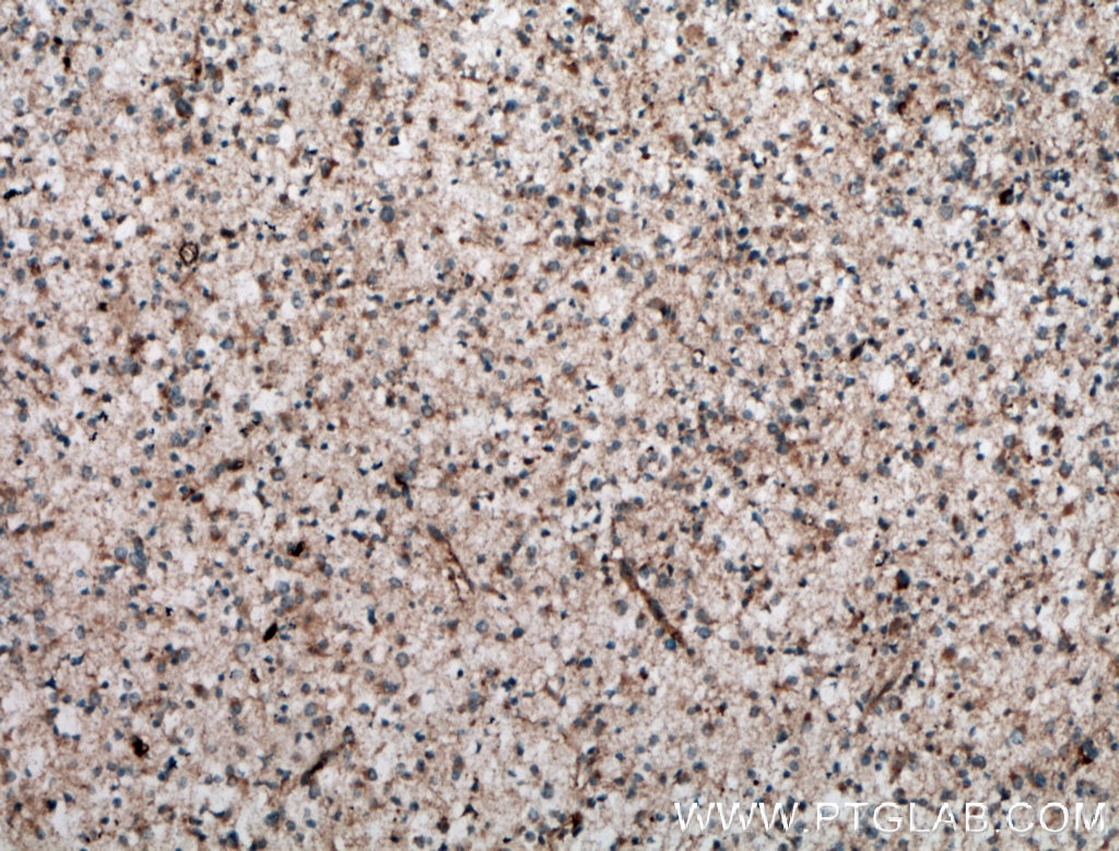 Immunohistochemistry (IHC) staining of human gliomas tissue using NKIAMRE Polyclonal antibody (13888-1-AP)