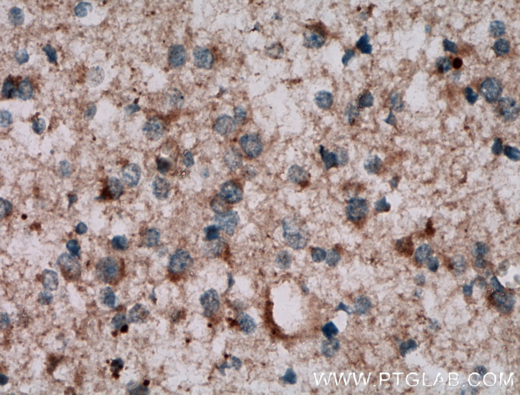 Immunohistochemistry (IHC) staining of human gliomas tissue using NKIAMRE Polyclonal antibody (13888-1-AP)