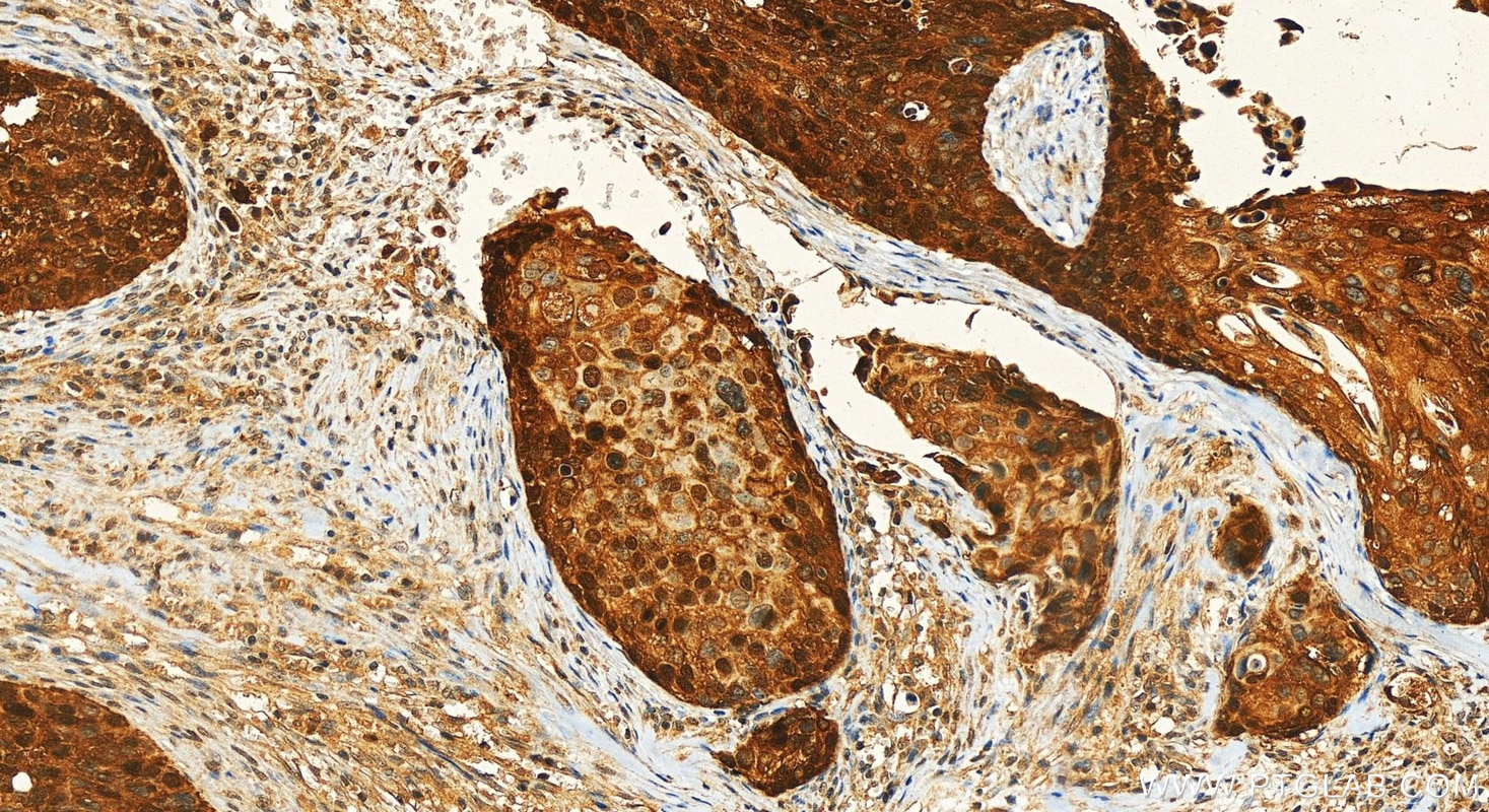 IHC staining of human cervical cancer using RMX00038 Immunohistochemistry (IHC) staining of human cervical cancer tissue using Multi-rAb® CDKN2A/P16-INK4A Multi-Recombinant anti (RMX00038)