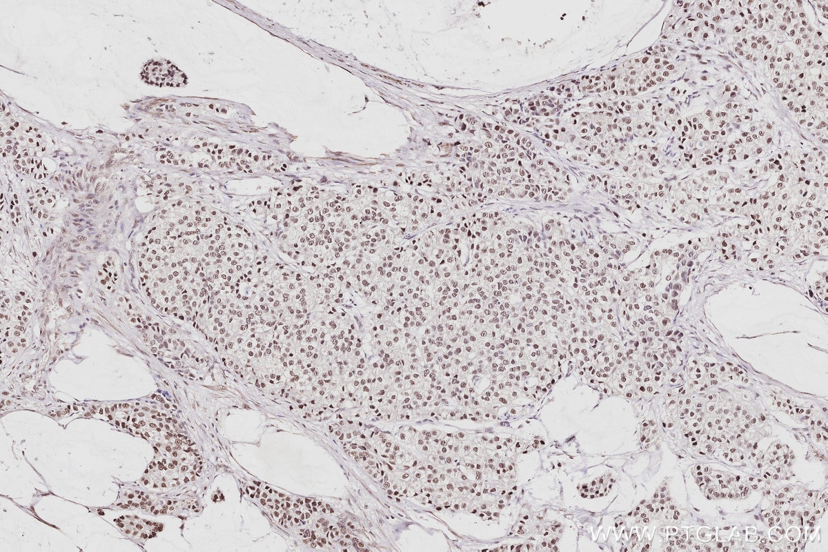 Immunohistochemistry (IHC) staining of human stomach cancer tissue using CDKN2AIP Polyclonal antibody (16615-1-AP)