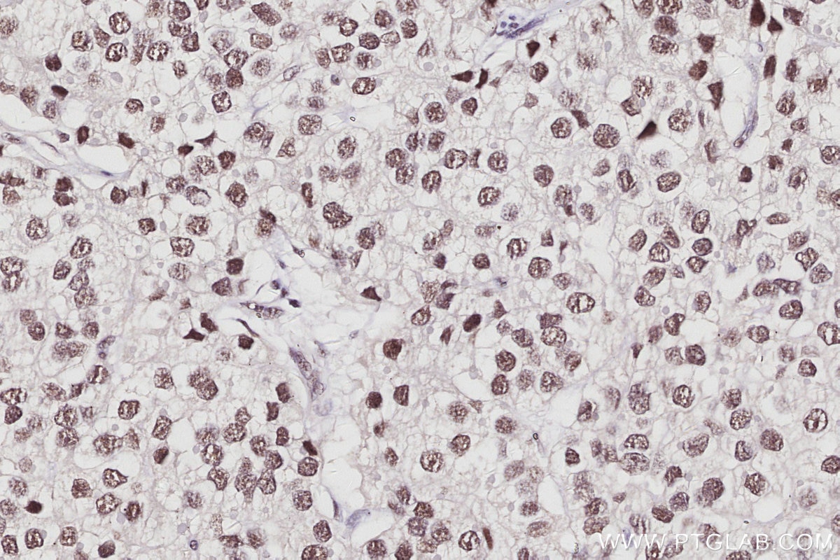 Immunohistochemistry (IHC) staining of human stomach cancer tissue using CDKN2AIP Polyclonal antibody (16615-1-AP)