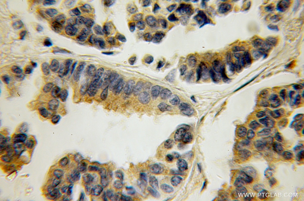 IHC staining of human breast cancer using 12993-1-AP