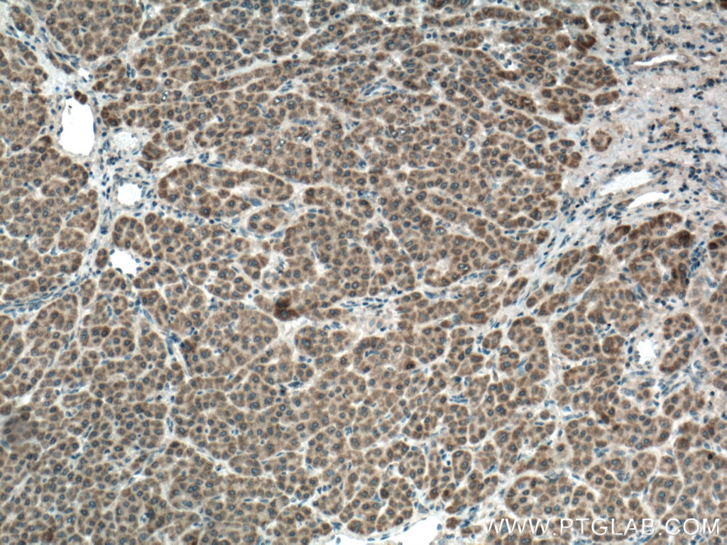 Immunohistochemistry (IHC) staining of human liver cancer tissue using CDO1 Polyclonal antibody (12589-1-AP)