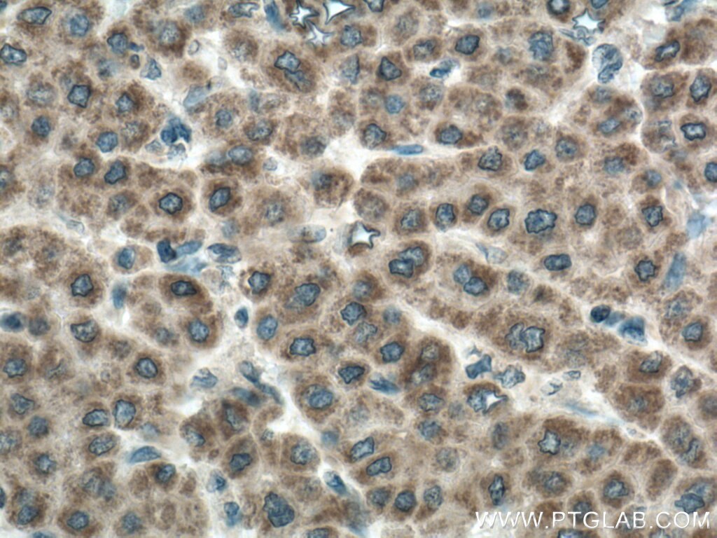 Immunohistochemistry (IHC) staining of human liver cancer tissue using CDO1 Polyclonal antibody (12589-1-AP)