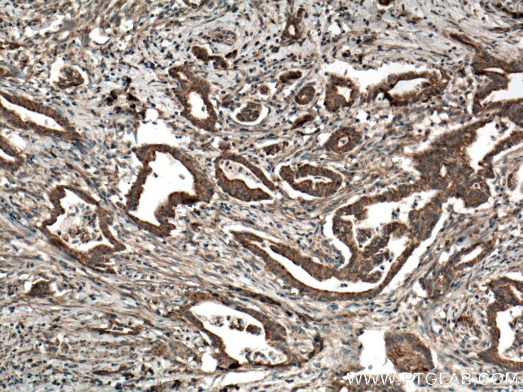 Immunohistochemistry (IHC) staining of human pancreas cancer tissue using CDO1 Polyclonal antibody (12589-1-AP)