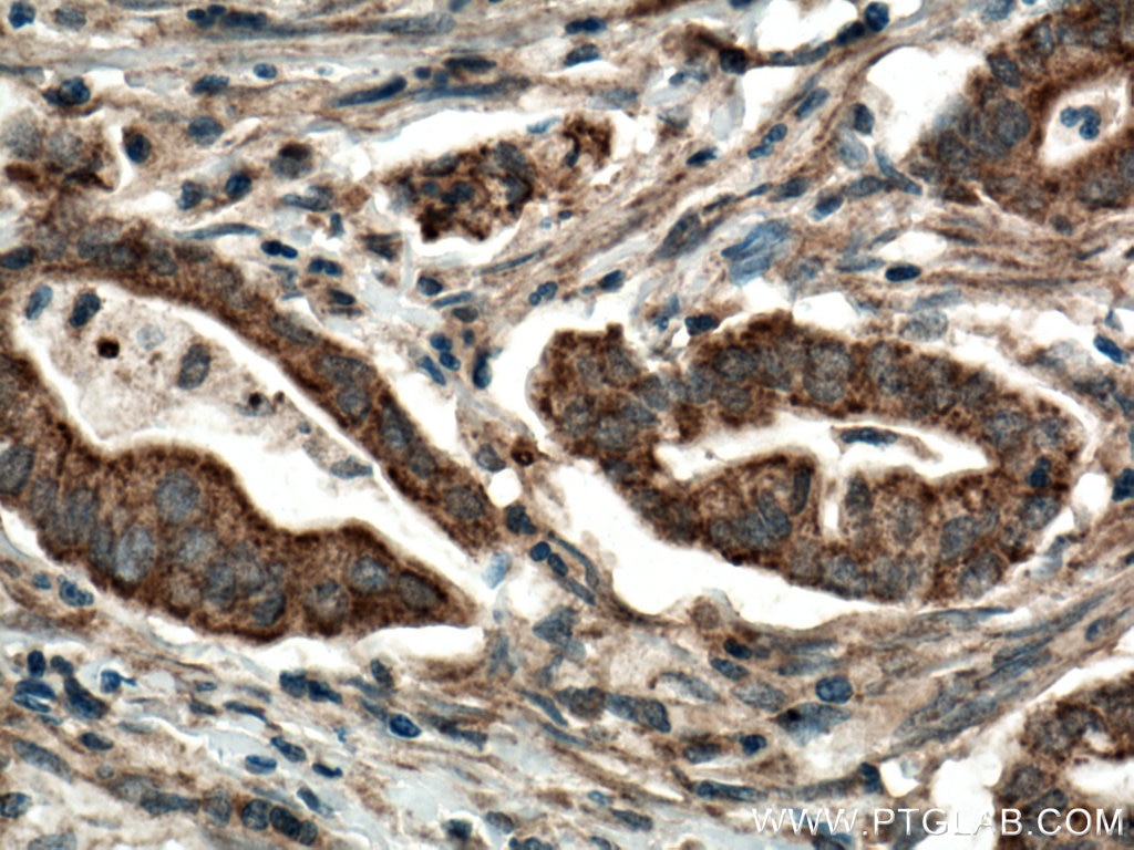 Immunohistochemistry (IHC) staining of human pancreas cancer tissue using CDO1 Polyclonal antibody (12589-1-AP)