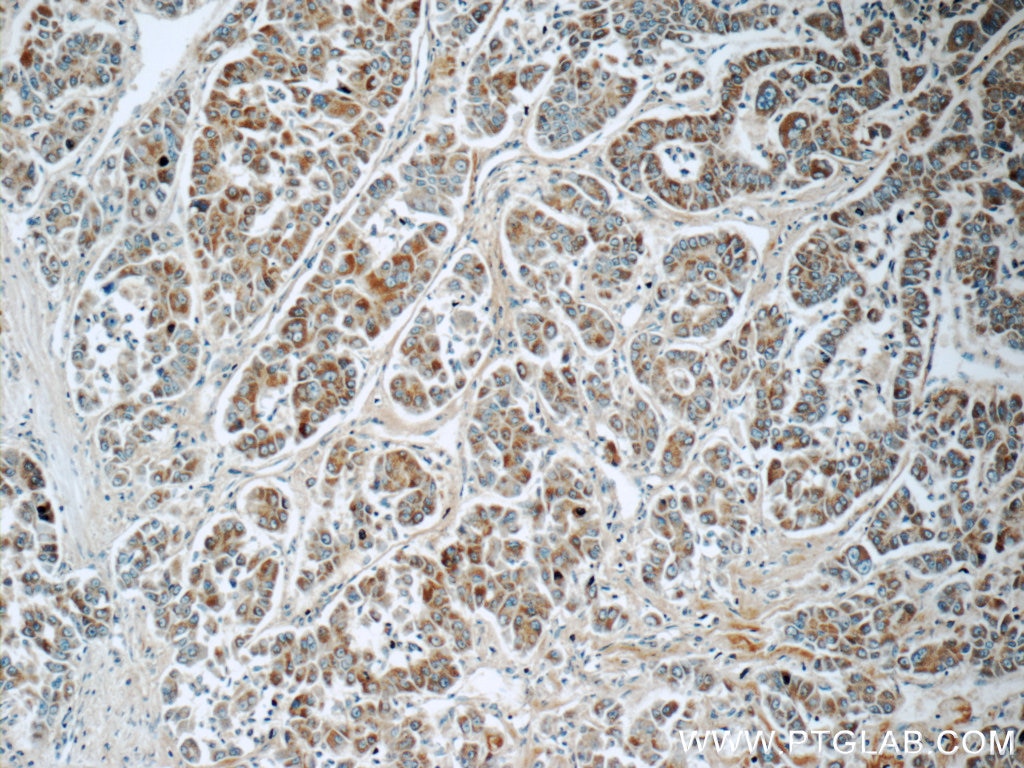 Immunohistochemistry (IHC) staining of human liver cancer tissue using CDO1 Polyclonal antibody (12589-1-AP)