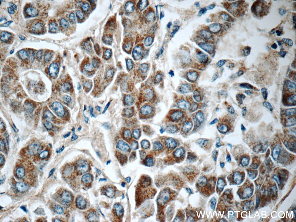 Immunohistochemistry (IHC) staining of human liver cancer tissue using CDO1 Polyclonal antibody (12589-1-AP)