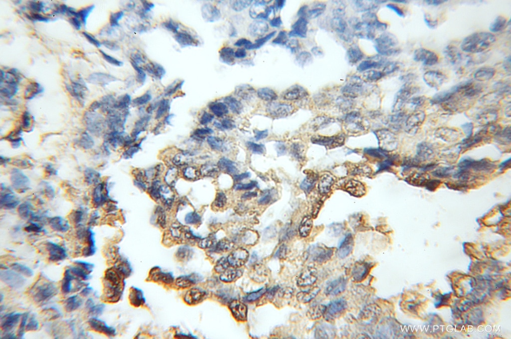 Immunohistochemistry (IHC) staining of human breast cancer tissue using CDR2 Polyclonal antibody (11611-2-AP)