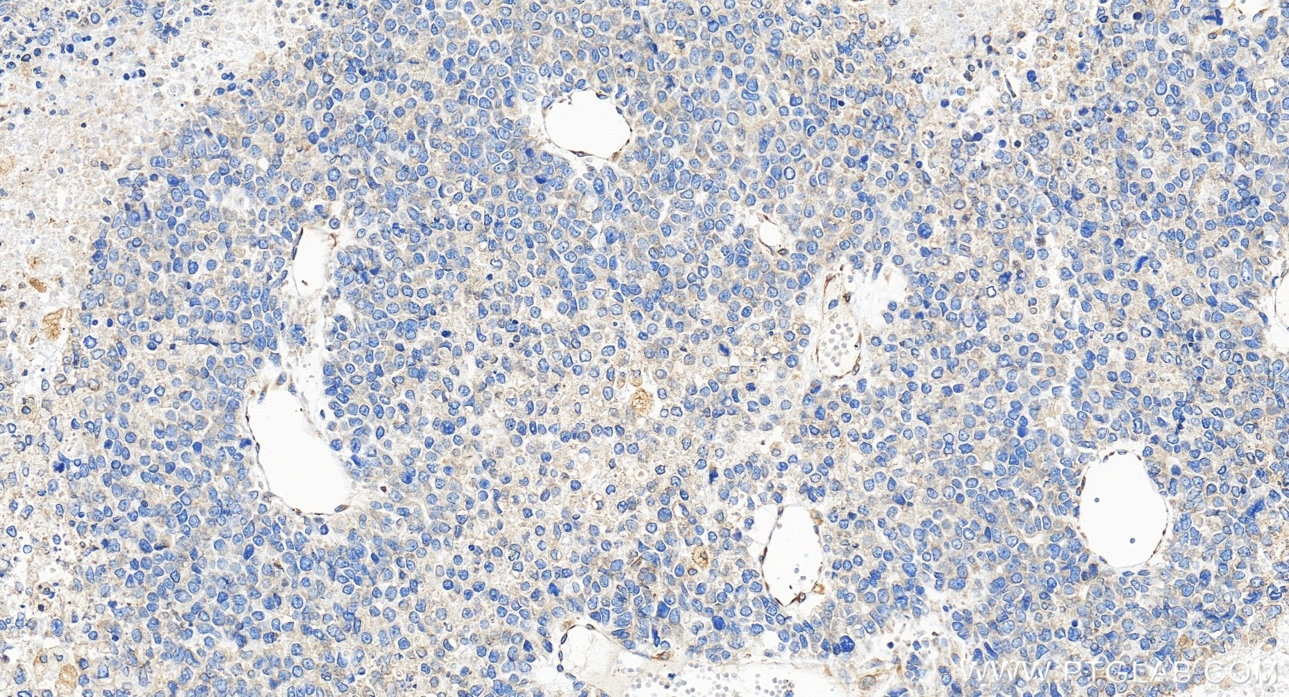 Immunohistochemical analysis of paraffin-embedded human liver cancer tissue slide using 85162-4-RR (CDS2 antibody) at dilution of 1:200 (under 20x lens). Heat mediated antigen retrieval with Tris-EDTA buffer (pH 9.0). Immunohistochemistry (IHC) staining of human liver cancer tissue using CDS2 Recombinant monoclonal antibody (85162-4-RR)