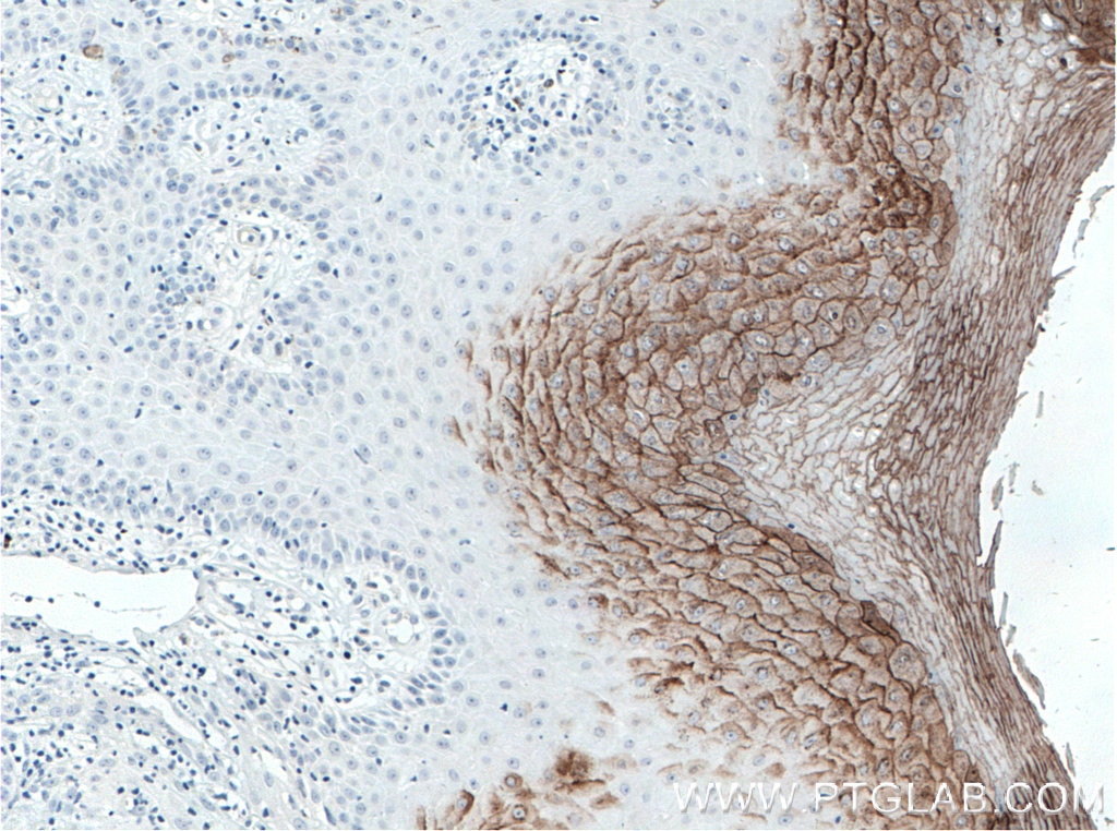 Immunohistochemistry (IHC) staining of human skin cancer tissue using CDSN Polyclonal antibody (13184-1-AP)