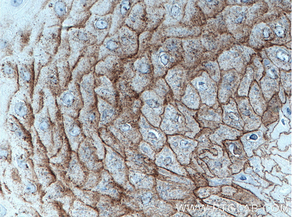 Immunohistochemistry (IHC) staining of human skin cancer tissue using CDSN Polyclonal antibody (13184-1-AP)