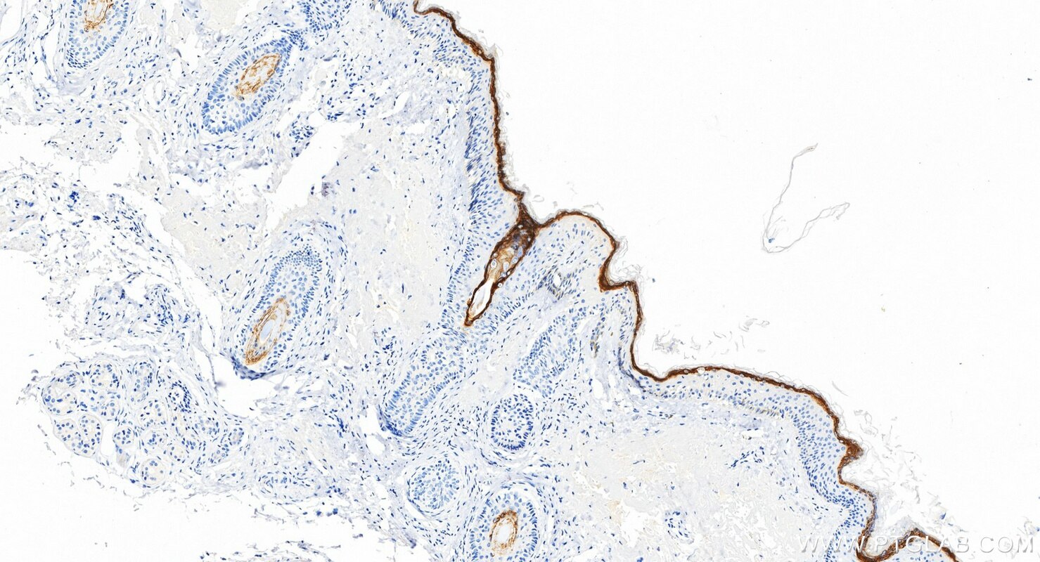 IHC staining of human skin cancer using 85384-2-RR (same clone as 85384-2-PBS) Immunohistochemistry (IHC) staining of human skin cancer tissue using CDSN Recombinant monoclonal antibody (85384-2-RR)