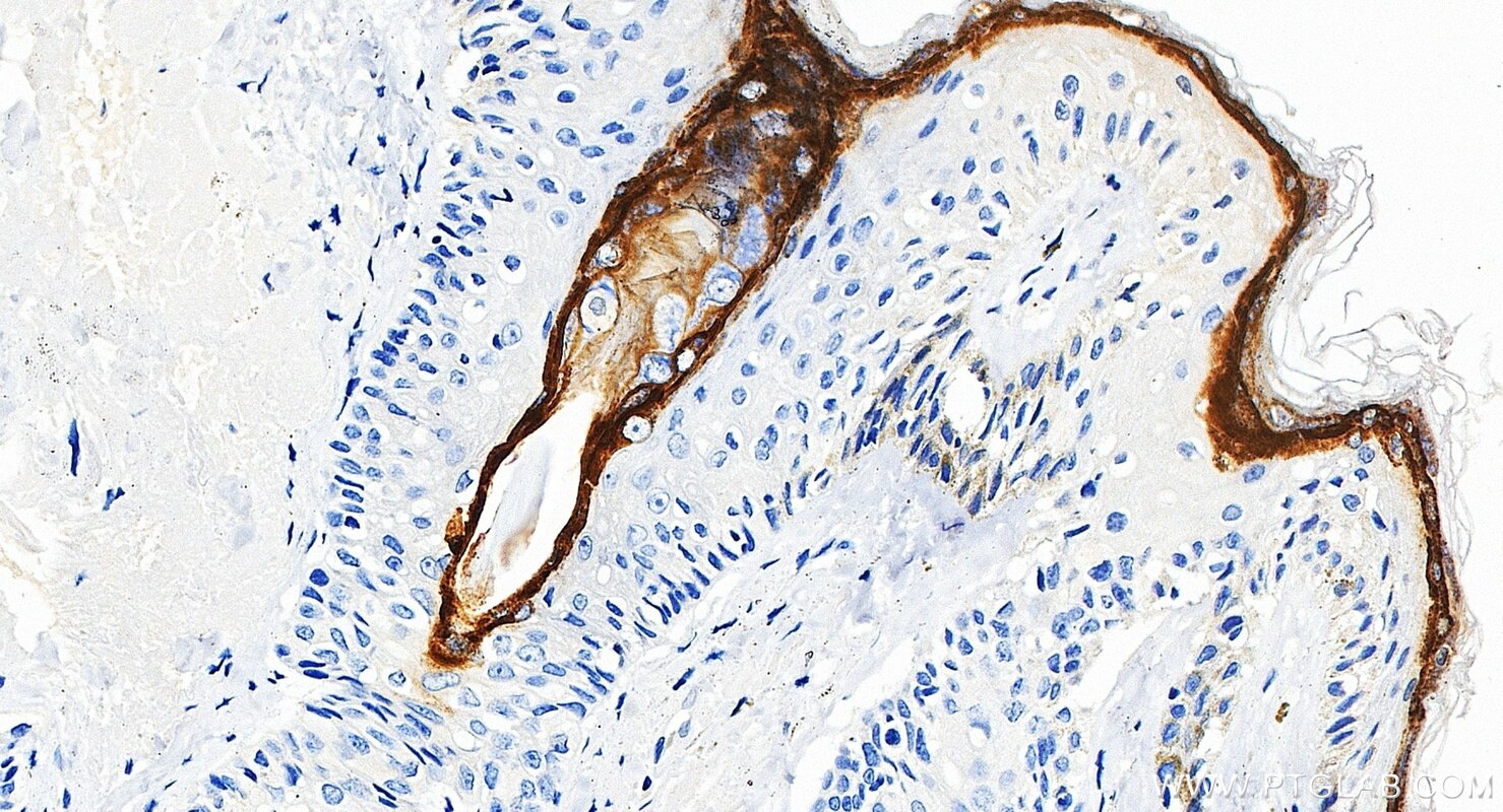 IHC staining of human skin cancer using 85384-2-RR (same clone as 85384-2-PBS) Immunohistochemistry (IHC) staining of human skin cancer tissue using CDSN Recombinant monoclonal antibody (85384-2-RR)