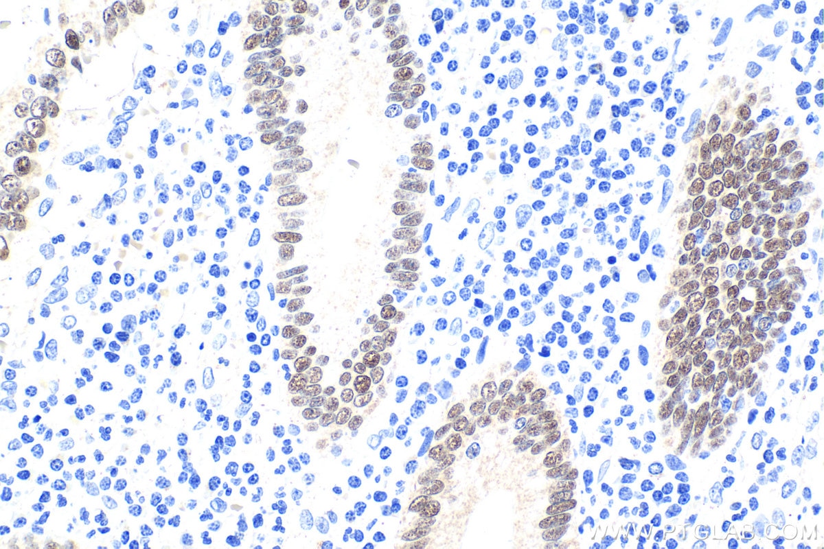 Immunohistochemistry (IHC) staining of human appendicitis tissue using CDX2 Polyclonal antibody (22101-1-AP)