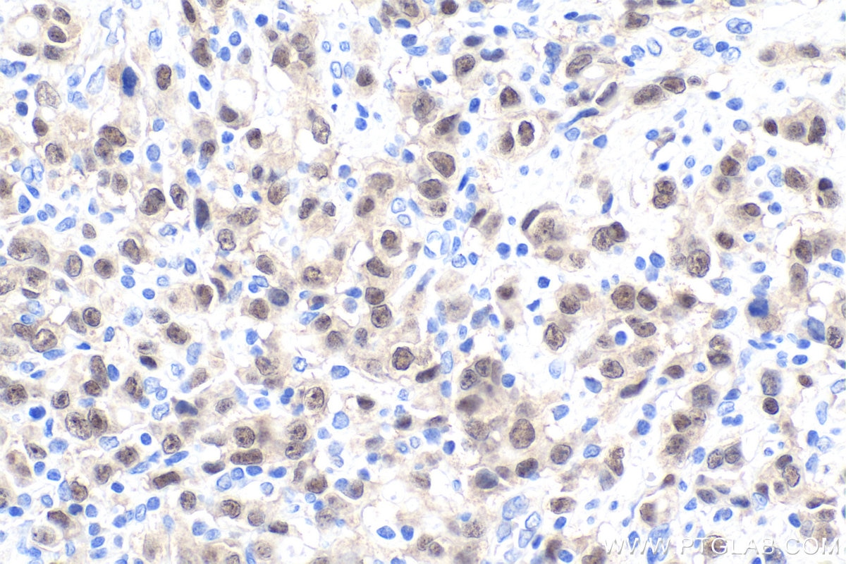 Immunohistochemistry (IHC) staining of human stomach cancer tissue using CDX2 Polyclonal antibody (22101-1-AP)