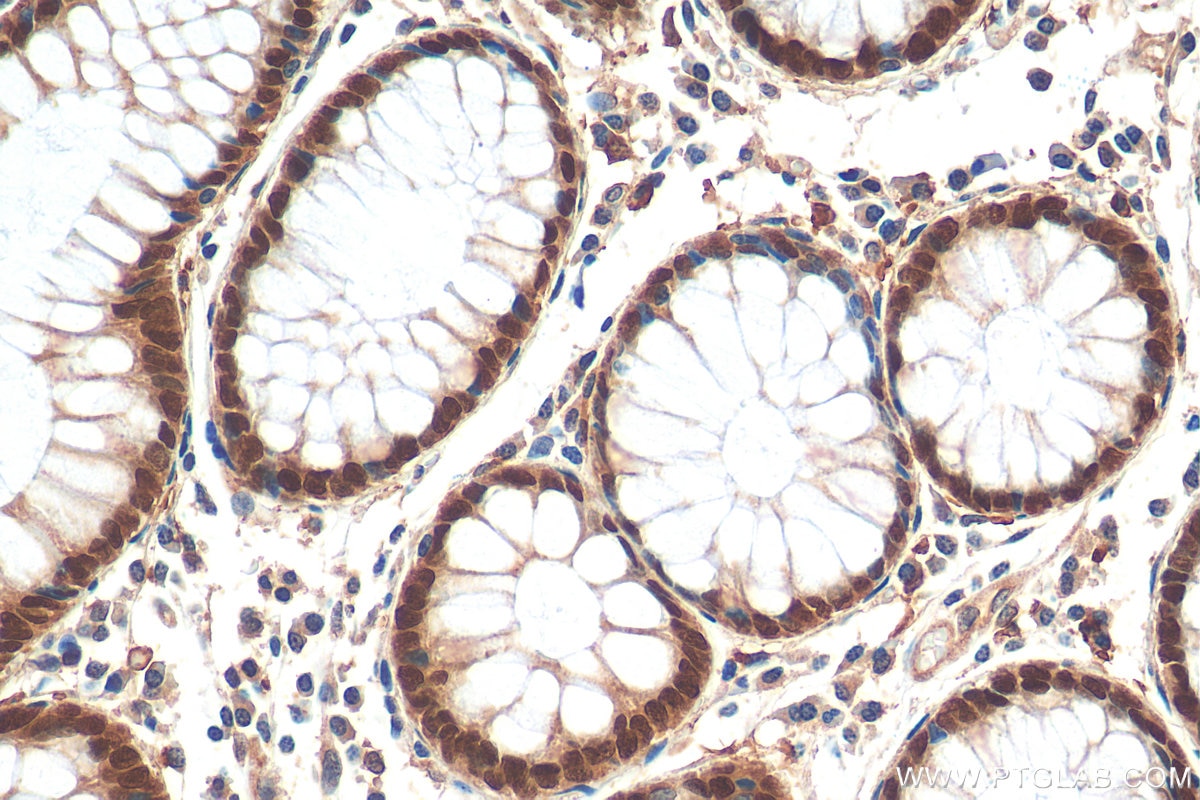 Immunohistochemistry (IHC) staining of human colon cancer tissue using CDX2 Polyclonal antibody (30380-1-AP)