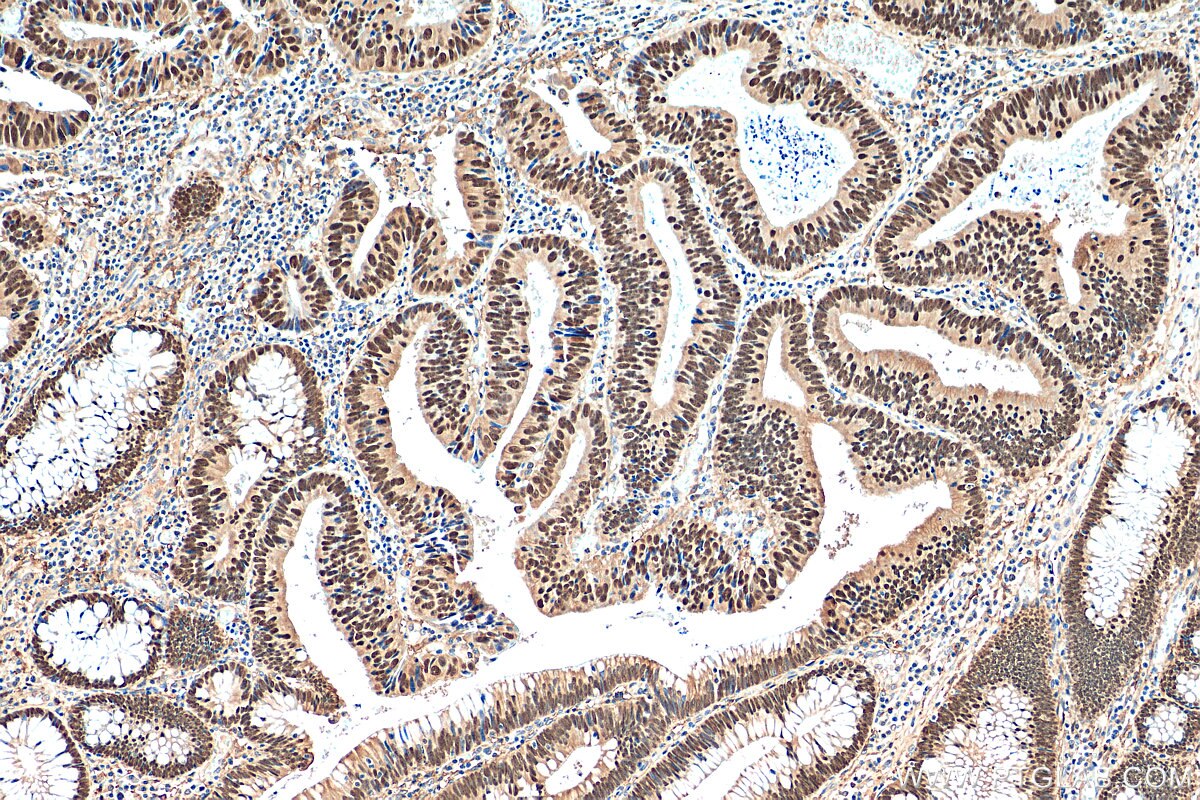 Immunohistochemistry (IHC) staining of human colon cancer tissue using CDX2 Polyclonal antibody (30380-1-AP)