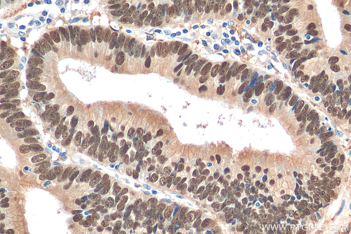 Immunohistochemistry (IHC) staining of human colon cancer tissue using CDX2 Polyclonal antibody (30380-1-AP)