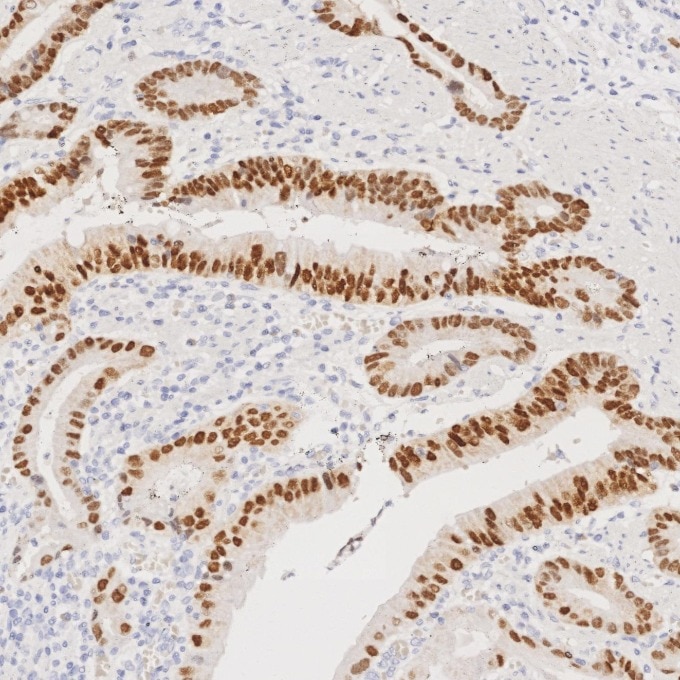IHC staining of human stomach cancer using 82659-1-RR Immunohistochemistry (IHC) staining of human stomach cancer tissue using CDX2 Recombinant monoclonal antibody (82659-1-RR)
