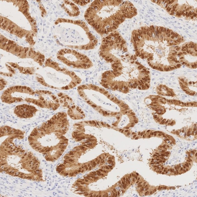 IHC staining of human colorectal cancer using 82659-1-RR Immunohistochemistry (IHC) staining of human colorectal cancer tissue using CDX2 Recombinant monoclonal antibody (82659-1-RR)
