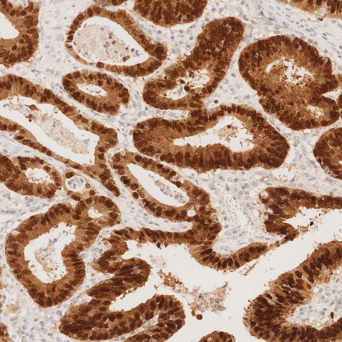 IHC staining of human colorectal cancer using 82659-1-RR Immunohistochemistry (IHC) staining of human colorectal cancer tissue using CDX2 Recombinant monoclonal antibody (82659-1-RR)