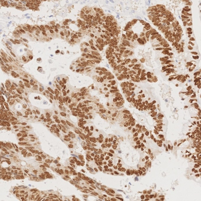 IHC staining of human colorectal cancer using 82659-1-RR Immunohistochemistry (IHC) staining of human colorectal cancer tissue using CDX2 Recombinant monoclonal antibody (82659-1-RR)