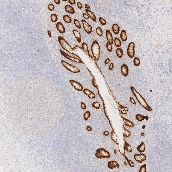 IHC staining of human appendicitis using 82659-1-RR Immunohistochemistry (IHC) staining of human appendicitis tissue using CDX2 Recombinant monoclonal antibody (82659-1-RR)