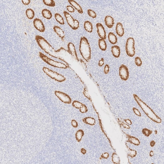IHC staining of human appendicitis using 82659-1-RR Immunohistochemistry (IHC) staining of human appendicitis tissue using CDX2 Recombinant monoclonal antibody (82659-1-RR)