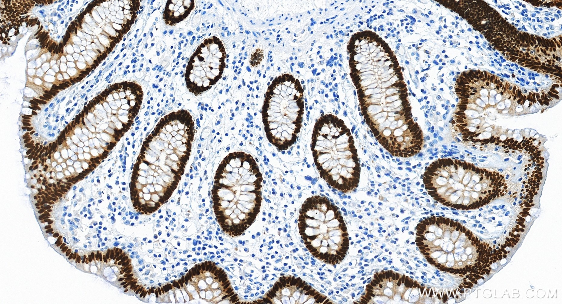Immunohistochemistry (IHC) staining of human colon tissue using CDX2 Recombinant monoclonal antibody (82663-1-RR)