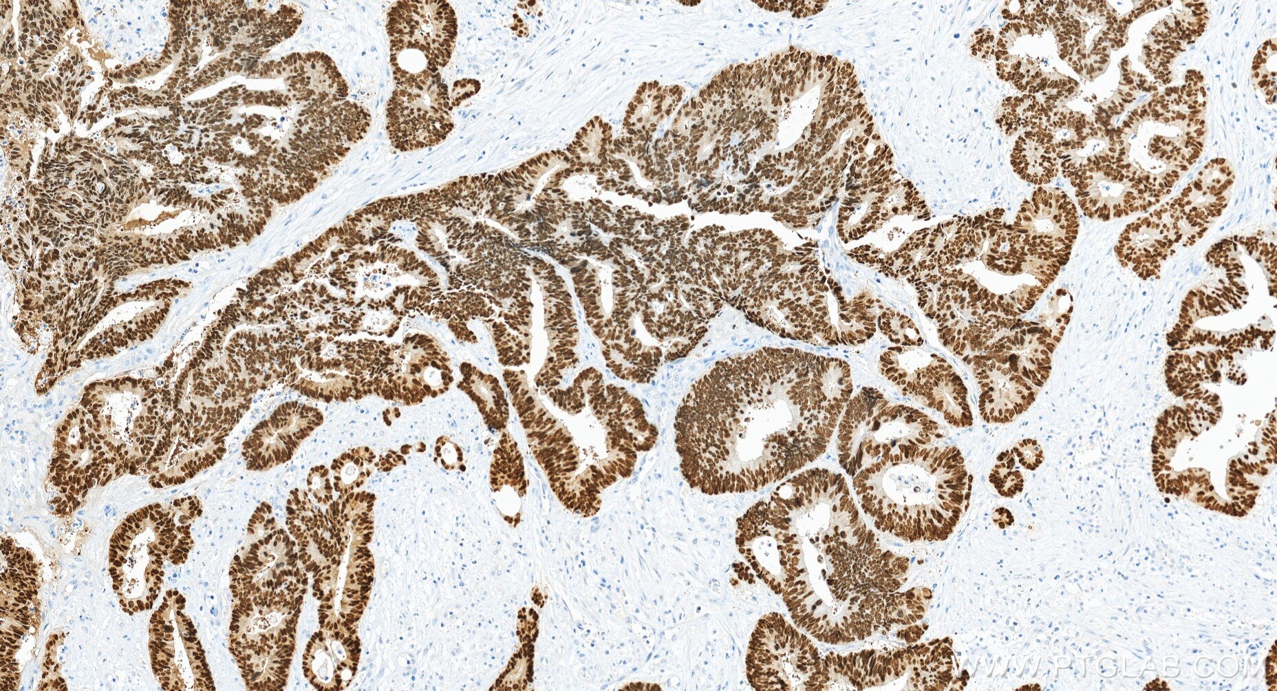 Immunohistochemistry (IHC) staining of human colon cancer tissue using CDX2 Recombinant monoclonal antibody (82663-1-RR)
