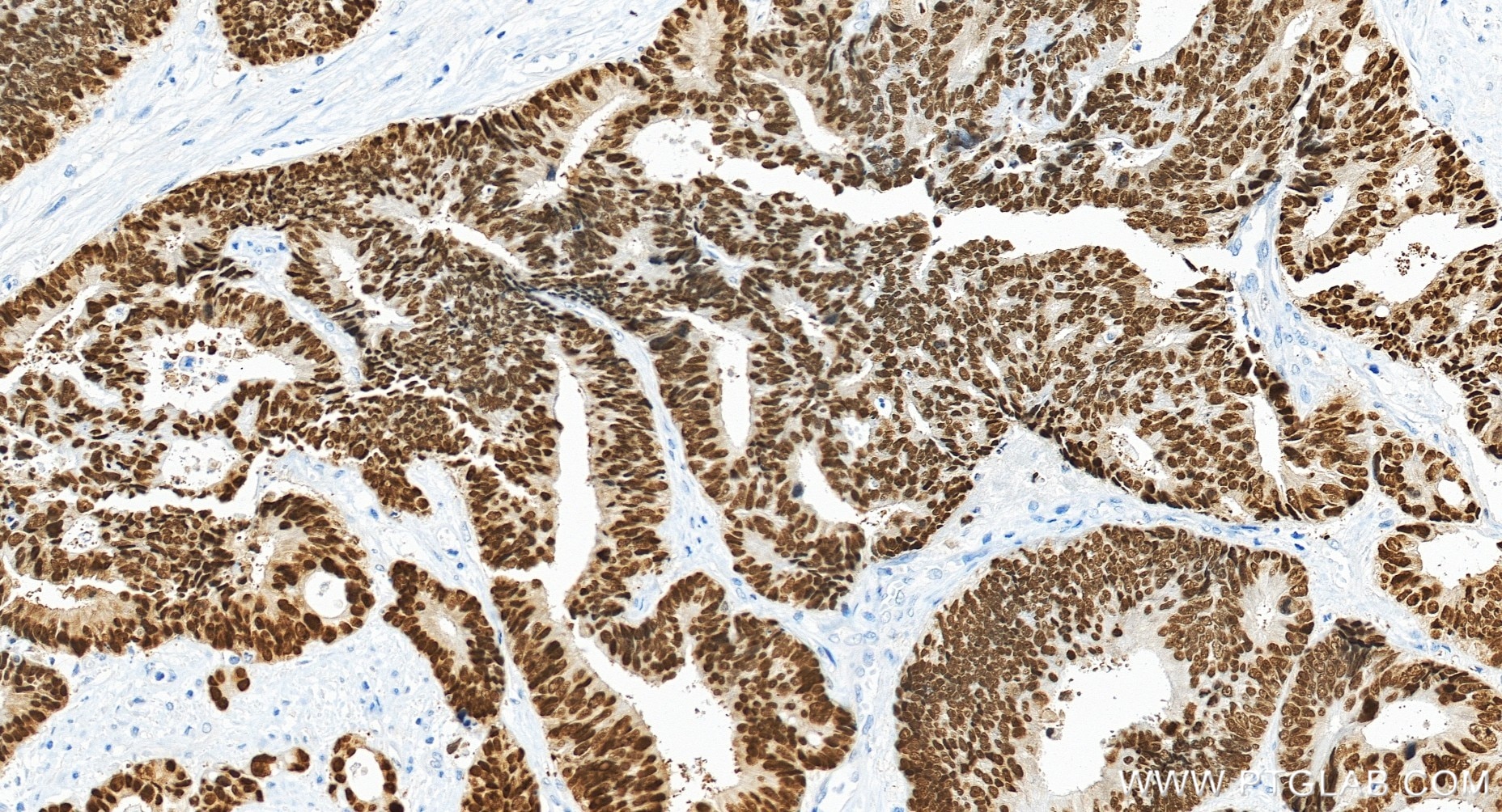 Immunohistochemistry (IHC) staining of human colon cancer tissue using CDX2 Recombinant monoclonal antibody (82663-1-RR)