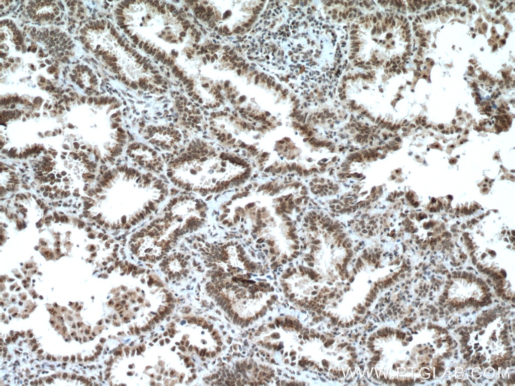 Immunohistochemistry (IHC) staining of human lung cancer tissue using CDYL Polyclonal antibody (17763-1-AP)