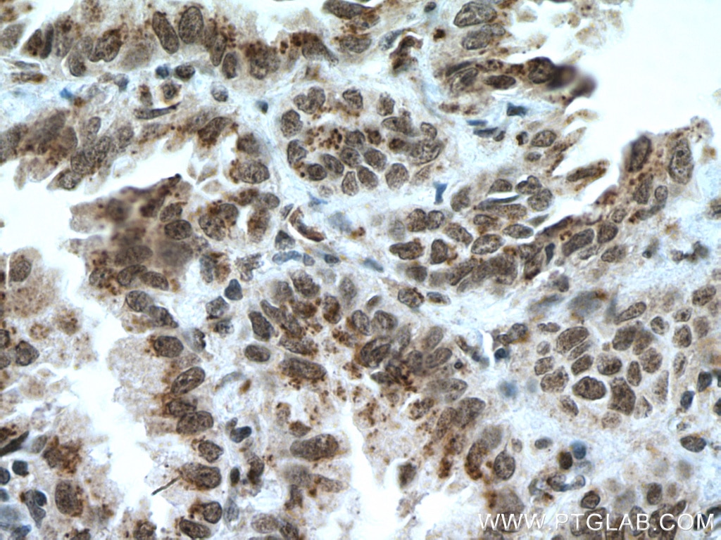 Immunohistochemistry (IHC) staining of human lung cancer tissue using CDYL Polyclonal antibody (17763-1-AP)
