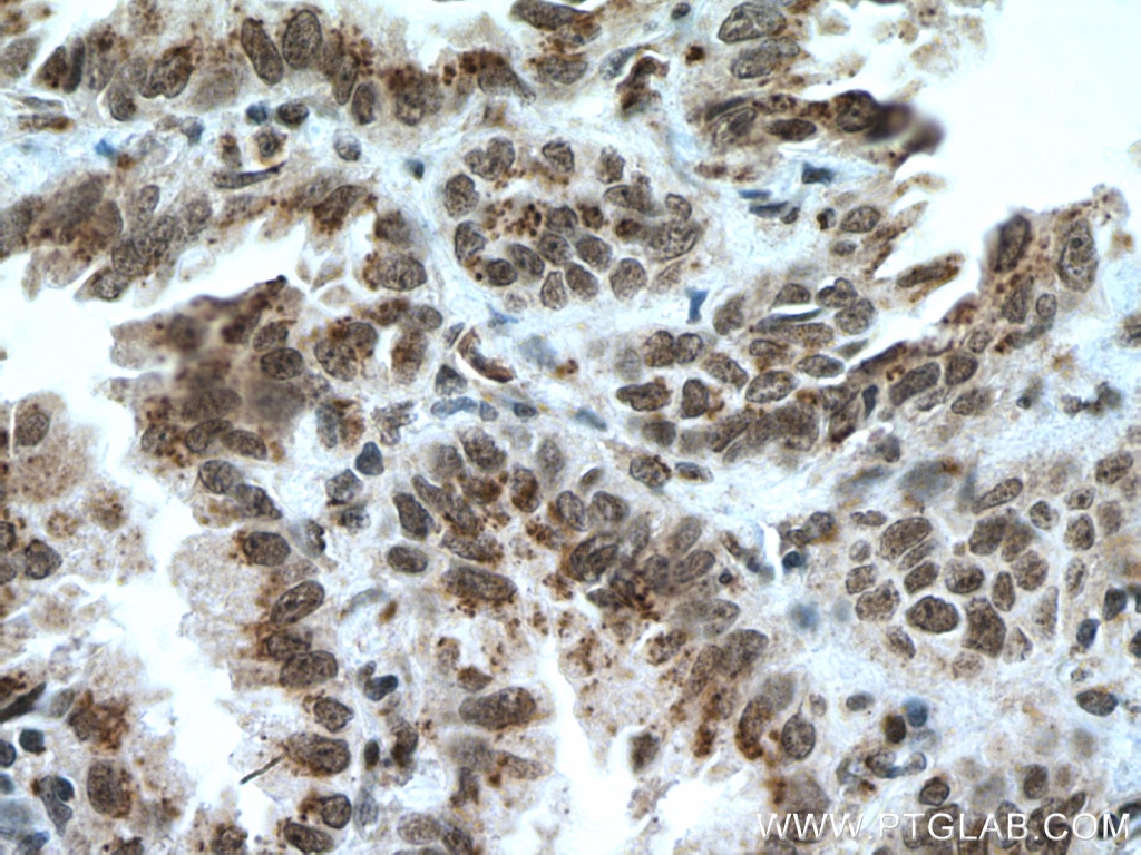 Immunohistochemistry (IHC) staining of human lung cancer tissue using CDYL Polyclonal antibody (17763-1-AP)