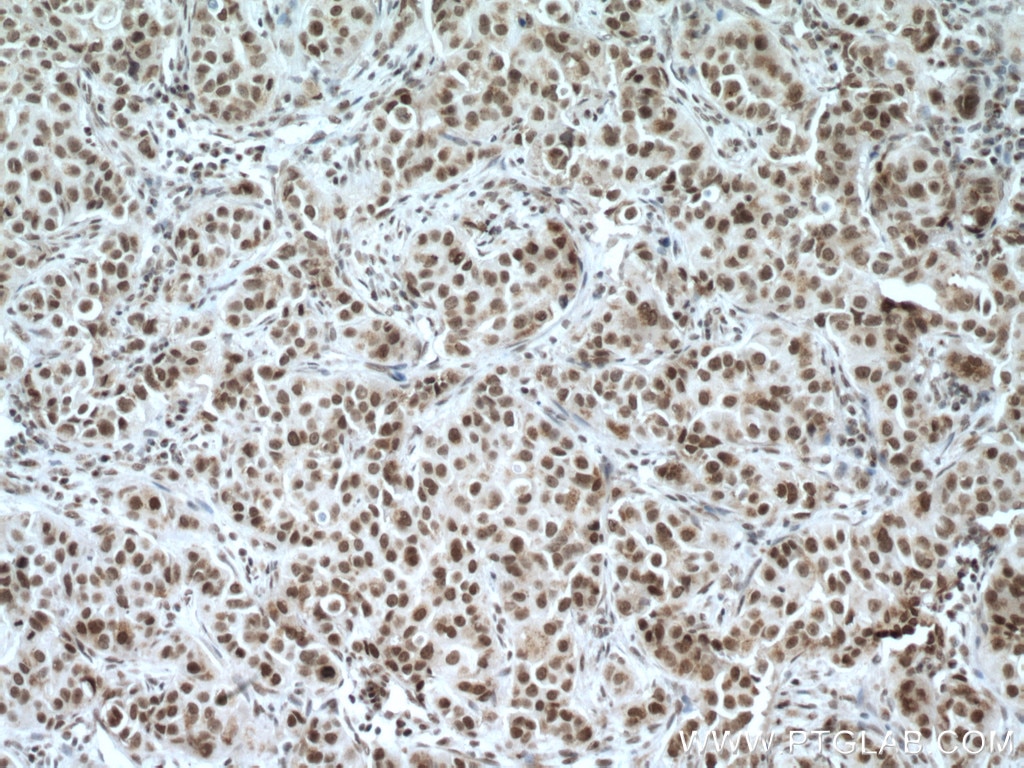 Immunohistochemistry (IHC) staining of human breast cancer tissue using CDYL Polyclonal antibody (17763-1-AP)