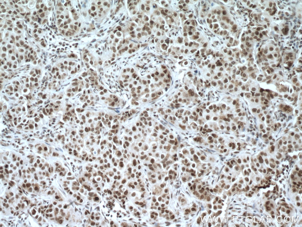 IHC staining of human breast cancer using 17763-1-AP