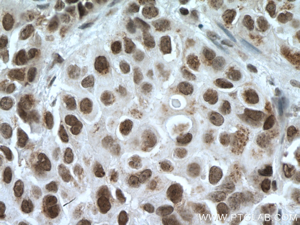 IHC staining of human breast cancer using 17763-1-AP