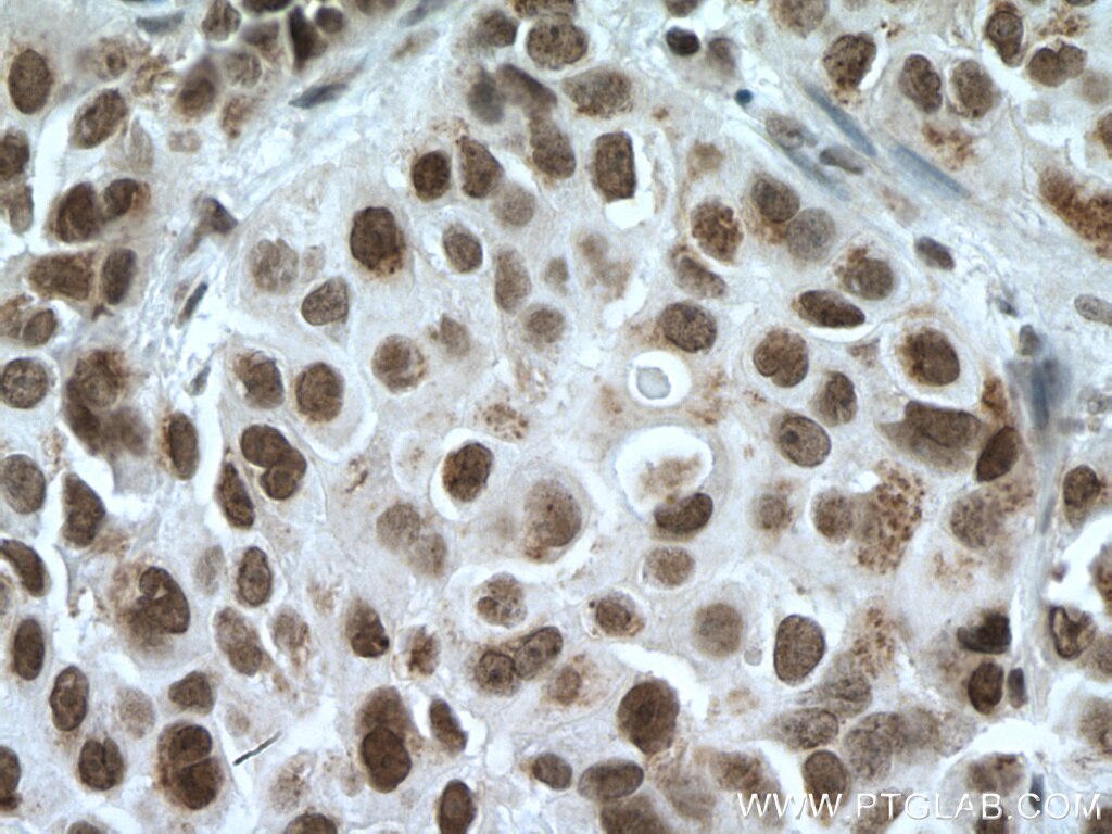 Immunohistochemistry (IHC) staining of human breast cancer tissue using CDYL Polyclonal antibody (17763-1-AP)